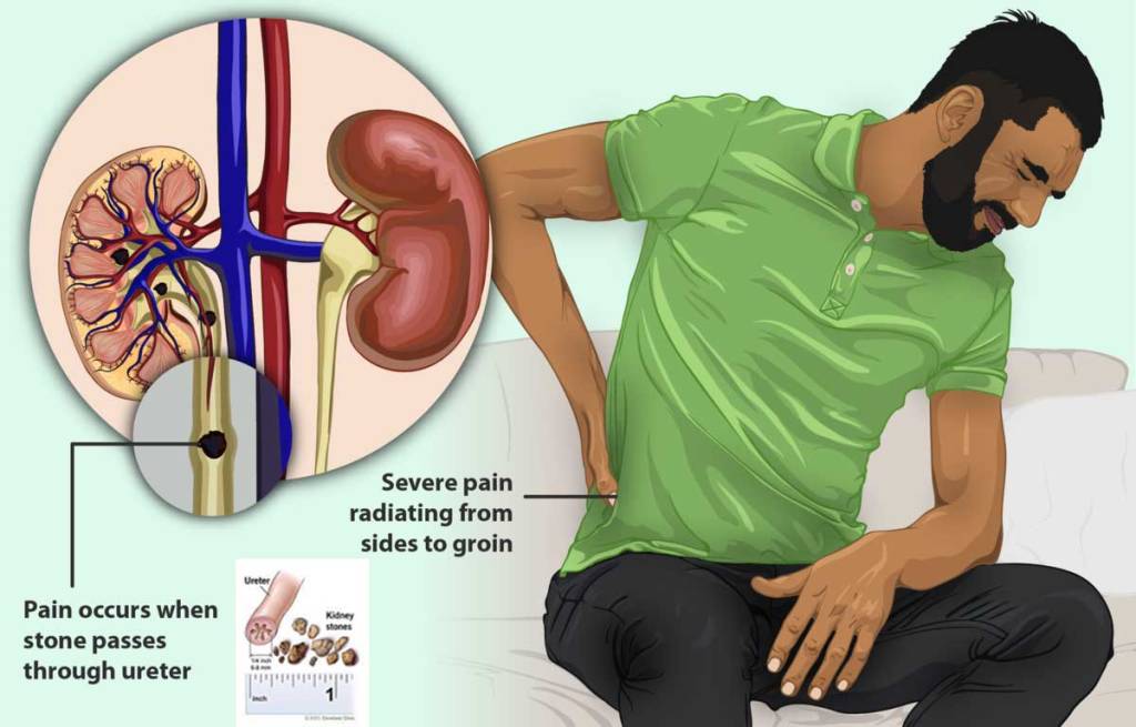 Movement of kidney stones